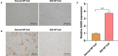 LncRNA GAS5 as miR-26a-5p Sponge Regulates the PTEN/PI3K/Akt Axis and Affects Extracellular Matrix Synthesis in Degenerative Nucleus Pulposus Cells in vitro